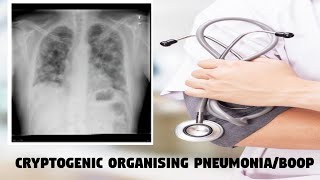 Cryptogenic organising Pneumonia  BOOP [upl. by Terese953]