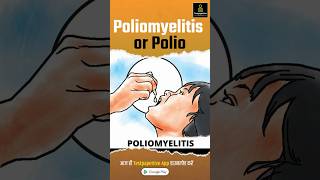 Poliomyelitis Hindi  Polio  Polio Virus  Causes Signs and Symptoms Polio Poliomyelitis [upl. by Pathe938]