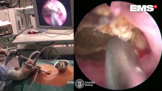 PNL Swiss LithoClast Master Ultrasound and Pneumatic Lithotripsy [upl. by Genevieve160]