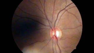 Optic Disc  Spontaneous Venous Pulsations [upl. by Casie737]