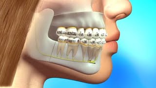 Quick straight teeth Braces How does Braces work process of Getting Braces  Amazing tooth [upl. by Siouxie174]