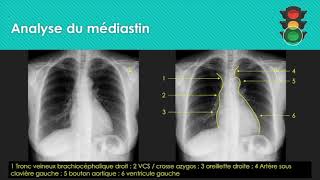 M1 Analyse de la radiographie thoracique médiastin [upl. by Simsar]