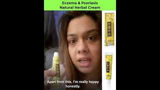 Free Eczema and Psoriasis Herbal Natural Treatment Cream that Works Like Magic to Cure Skin Disease [upl. by Janot499]