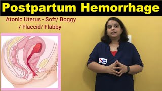 POSTPARTUM HEMORRHAGE  NCLEX REVIEW [upl. by Enelrak570]