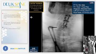 Deuk Plasma Rhizotomy DPR for Facet Joint Syndrome  C5C6 C6C7 [upl. by Mauchi]