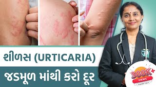 Ayurvedic Treatment Of Urticaria  Dr Devangi Jogal  JOGI Ayurved [upl. by Eizzo207]