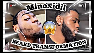 Minoxidil Beard  5 Month Beard Transformation  2022 Update With Pictures [upl. by Amme18]