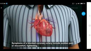 Myocardial Infarction in Hindi Part 2 by Dr Maulik Patel [upl. by Nylhsa741]