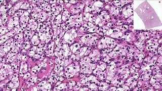 Clear Cell Renal Cell Carcinoma  Histopathology [upl. by Priscella]