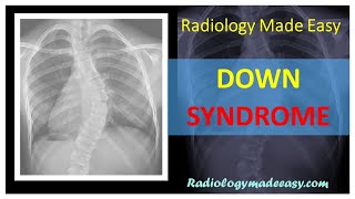 Radiological features of DOWN SYNDROME  Trisomy 21 [upl. by Arnie562]