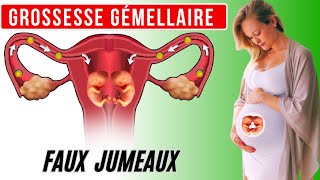 Grossesse gémellaire mécanisme de formation des faux jumeaux [upl. by Laen]