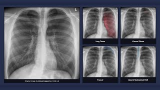 Simple Pneumothorax Explanation of Chest Xray Findings [upl. by Arihaj973]