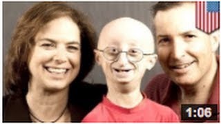 Le progeria une maladie génétique extrêmement rare [upl. by Oicatsana]