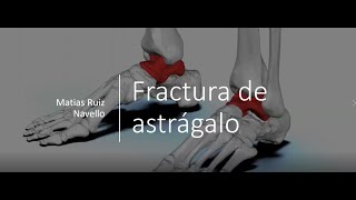 Fráctura de astrágalo  Dr Ruiz Navello [upl. by Thacher]