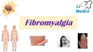 Fibromyalgia  Symptoms Associated Conditions Diagnosis Treatment [upl. by Romalda]