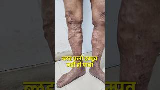 Is Varicose veins and deep vein thrombosis related  varicosevein dvt youtubeshorts shortvideo [upl. by Jeanie792]