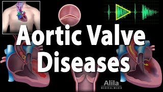 Aortic Valve Disease Animation [upl. by Deehahs]