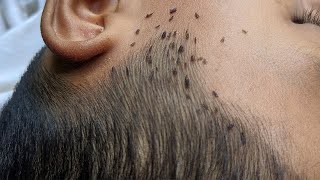 How to get rid hundred lice from short hair  Remove all big lice from black hair [upl. by Oicanata445]