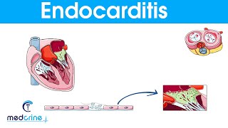 Endocarditis  causes symptoms pathophysiology diagnosis and treatment [upl. by Rosel]