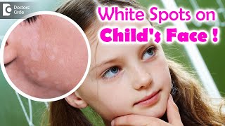 5 Things to know if your child is suffering from Pityriasis Alba  Dr Divya SharmaDoctors Circle [upl. by Enair]