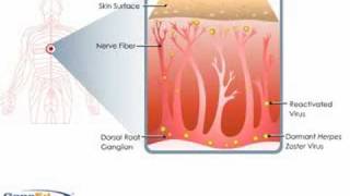 Shingles Pathophysiology [upl. by Blasien984]