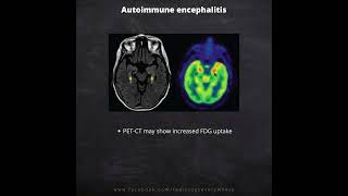 Autoimmune Encephalitis Radiological imaging [upl. by Slocum]