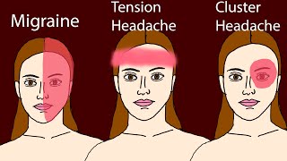 Headache  Common headaches Migraine Tension headache Cluster headache [upl. by Nospmis]