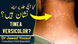 Tinea versicolor skin infection children  treatment  Causes  In Hindi Urdu Healers Online [upl. by Puff687]