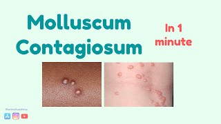 Molluscum Contagiosum Causes symptoms and treatment [upl. by Yatnwahs]