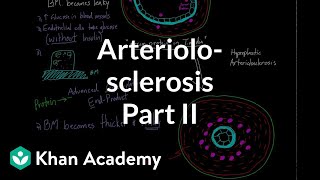 Arteriolosclerosis  part 2  Circulatory system diseases  Health amp Medicine  Khan Academy [upl. by Aicemaj628]