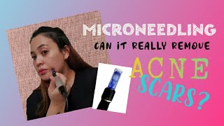 DIY MICRONEEDLING  You wont believe the result [upl. by Anohr148]