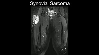 Synovial Sarcoma 1 [upl. by Nennerb]