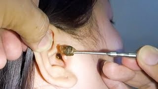 Removing One HUGE EARWAX Stuck in Womans Ear [upl. by Alihs]