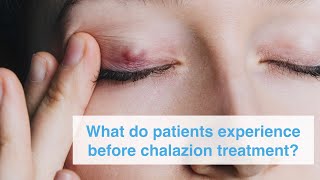 What do patients experience before chalazion treatment [upl. by Illene542]