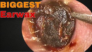 BIGGEST Earwax Difficult Removal EP 10  Doctor Anh [upl. by Homere]