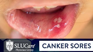 Determining Causes amp Treatment for Canker Sores  SLUCare Otolaryngology [upl. by Atenaz]