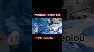 Percutaneous nephrolithotomy PCNL minimally invasive keyhole procedure to remove kidney stones [upl. by Nomde70]