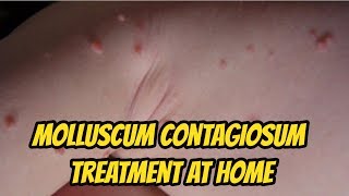 Molluscum contagiosum Treatment At Home [upl. by Akirahs]