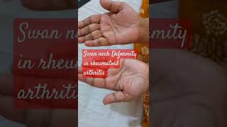 Swan neck deformity in Rheumatoid Arthritis [upl. by Flita941]