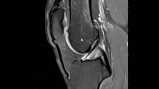 Fatty impingement in anterior knee [upl. by Allebasi]