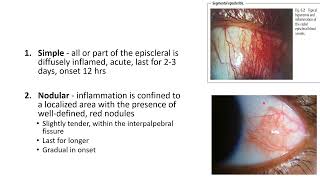 EPISCLERITIS AND SCLERITIS [upl. by Beuthel]