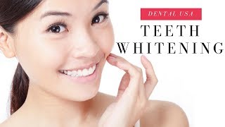 Davinci teeth whitening [upl. by Aihsot]