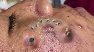 Big Cystic Acne Blackheads Extraction Blackheads amp Milia Whiteheads Removal Pimple Popping 090 [upl. by Elfie145]