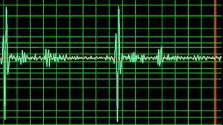 Aortic Regurgitation Ejection Systolic Murmur normal speed [upl. by Erdnael]