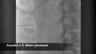 Percutaneous Nephrostomy [upl. by Yor]