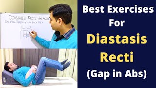 Exercises For Diastasis Recti Abdominal Seperation Diastasis Recti Treatment Reason of Back Pain [upl. by Pauly]