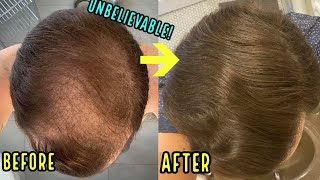 HE REGREW HIS BALD HEAD USING THESE 3 SIMPLE HAIR LOSS TREATMENTS [upl. by Utham39]