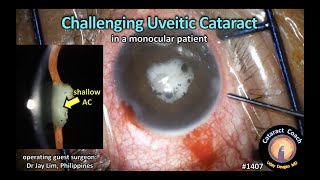 CataractCoach 1407 challenging uveitic cataract [upl. by Nnylrahc467]