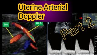 Obstetrics Doppler ultrasoundUterine artery Doppler ultrasound [upl. by Ailedua]