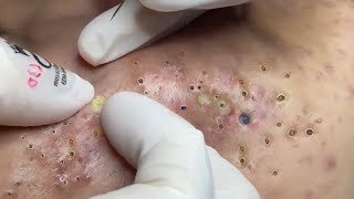 Big Cystic Acne Blackheads Extraction Blackheads amp Milia Whiteheads Removal Pimple Popping  292 [upl. by Elleinnad]